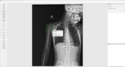 基于深度学习YOLOv8和YOLOv5的骨折检测骨折识别医学骨科诊断系统设计-创享日记