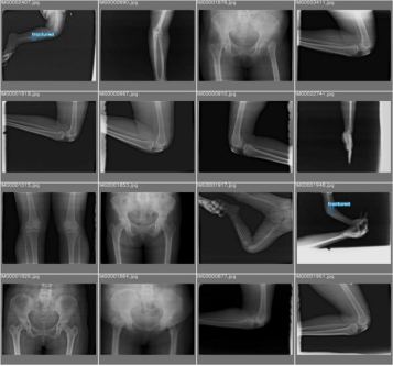 基于深度学习YOLOv8和YOLOv5的骨折检测骨折识别医学骨科诊断系统设计-创享日记