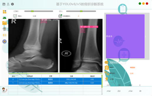 基于深度学习YOLOv8和YOLOv5的骨折检测骨折识别医学骨科诊断系统设计-创享日记