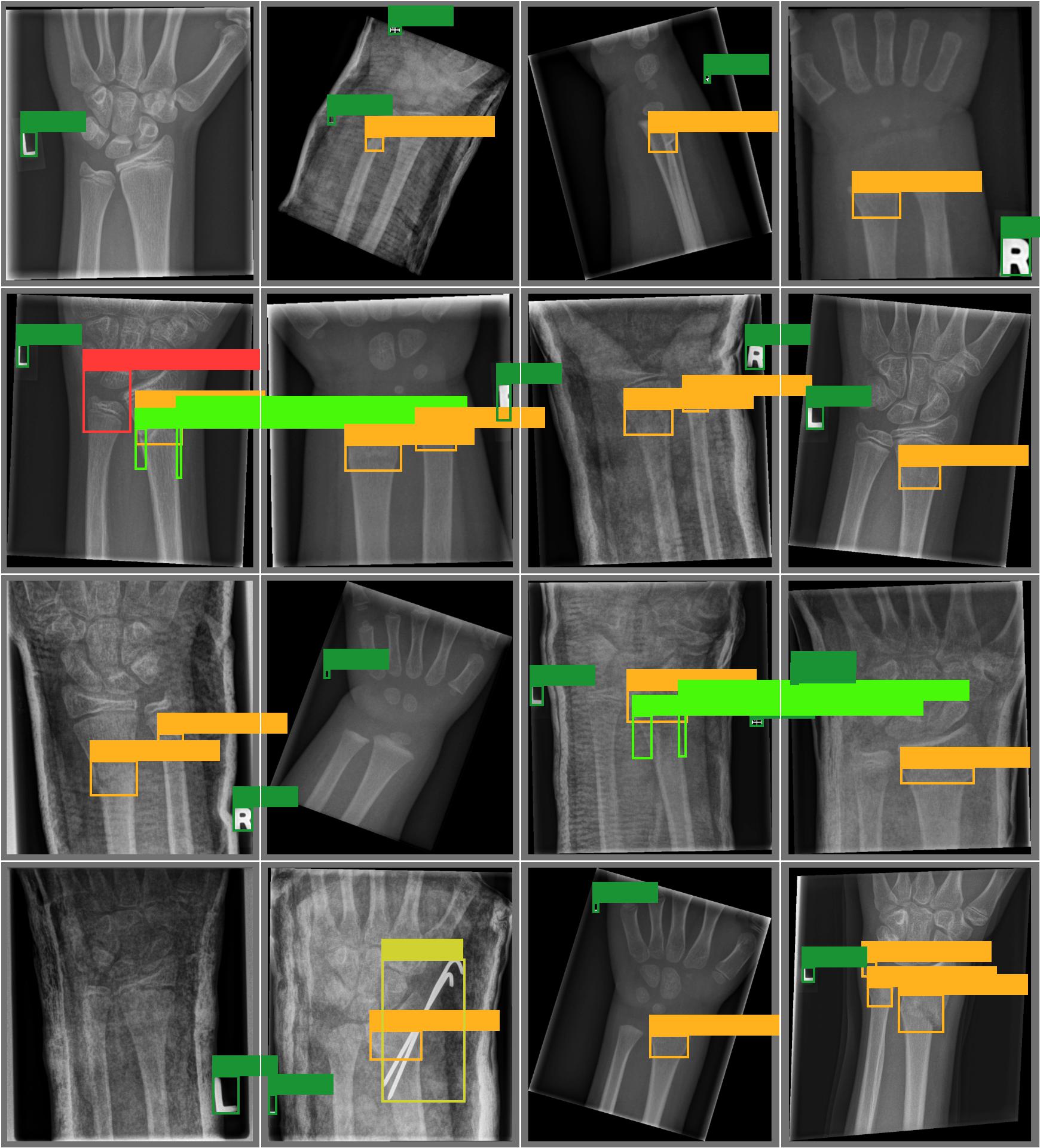基于深度学习YOLO的手臂骨折手腕骨折检测儿童骨科诊断骨科X光片数据集-创享日记
